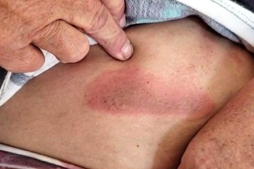 A vítima teve queimadura na barriga (Foto: Carioca/Notícias Policiais)