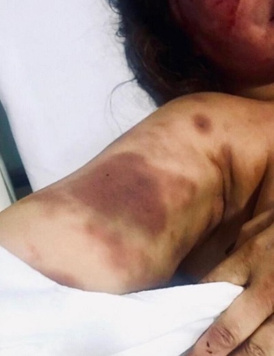 Elaine Caparróz sofreu fraturas no rosto e hematomas pelo corpo. (Foto: Reprodução/Instagram @kyragracie)