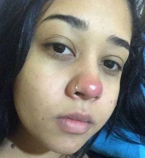 Bolha vermelha no nariz apareceu em julho (Foto: Acervo pessoal)