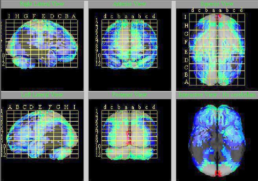 Estudo mostra déficits no cérebro de  paciente com patologia neurodegenerativa (Foto: Estudo cerebral)
