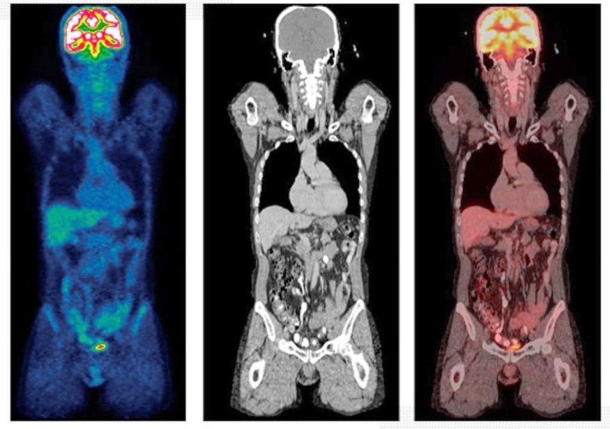 EXAME de corpo inteiro: imagem metabólica, anatômica e a fusão das duas (Foto: PET-CT ONCOLÓGICO)