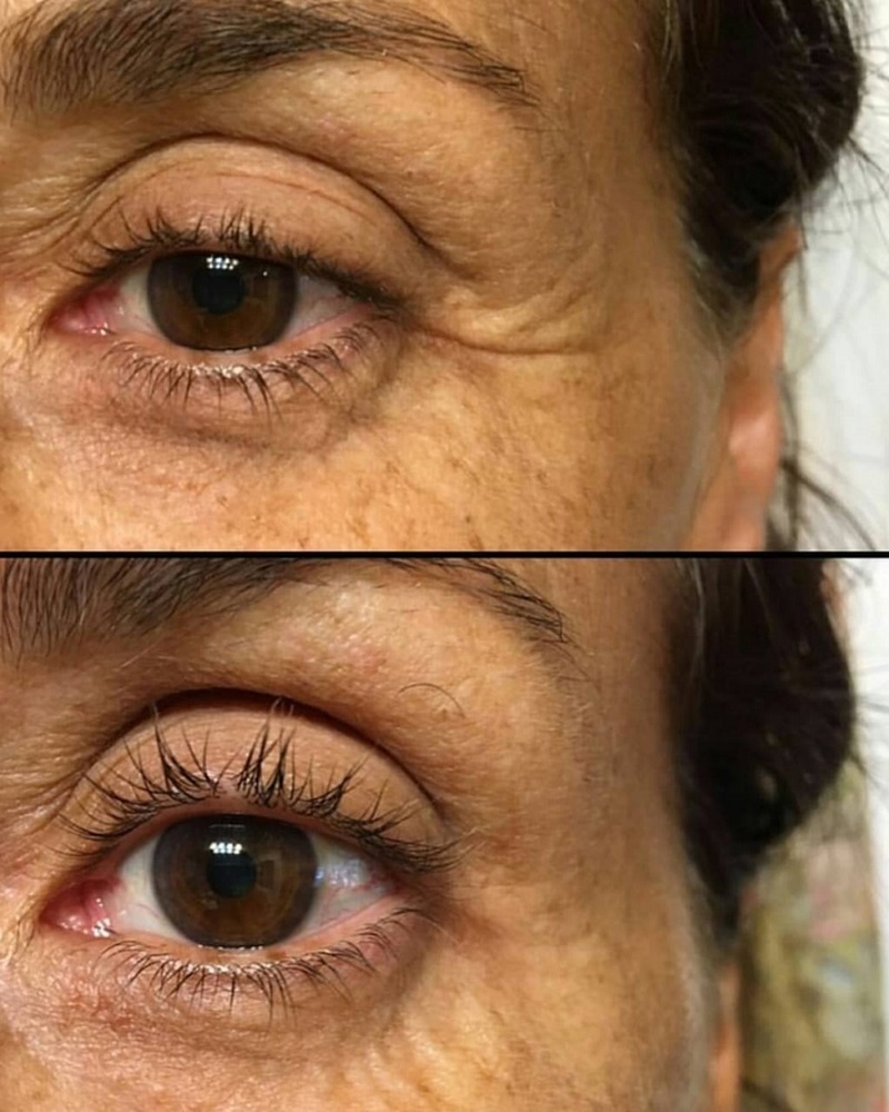 Resultado do antes e depois das pálpebras tratadas com o  Plasmalift, usado também no pescoço, lábios e abdômen. (Foto:  Divulgação/RF)