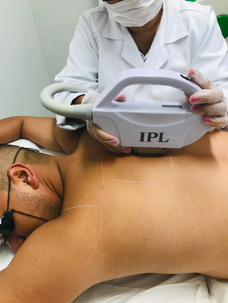 Homem depila as costas, o processo utiliza luz pulsada para queimar raiz do pelo. (Foto: Divulgação/Não Mais Pelo)