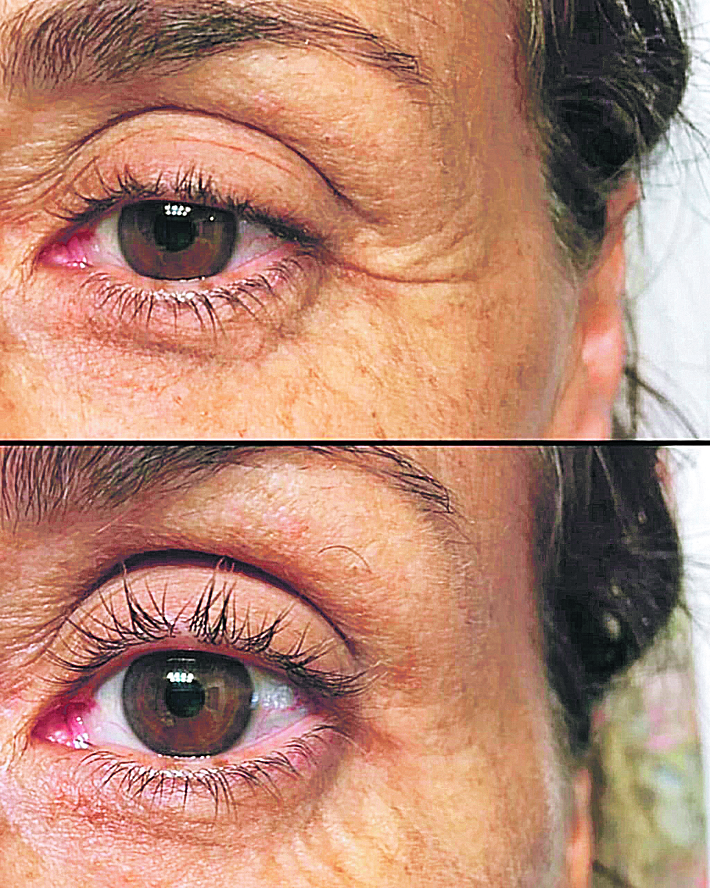 Antes e depois das pálpebras tratadas com o  Plasmalift, usado também no pescoço, lábios e abdômen. (Foto: RF)