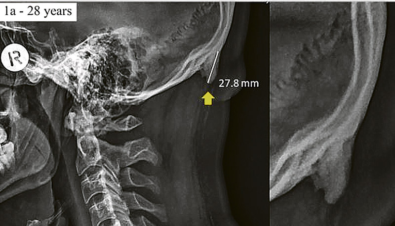 Protuberância na parte de trás do crânio: pesquisadores dizem que é causada por dobrar cabeça para ver tela (Foto: Reprodução/Nature)