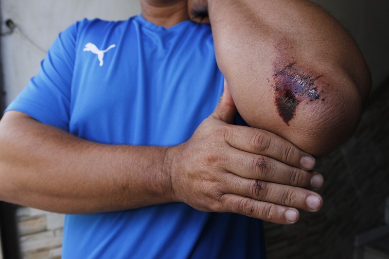 Vítima mostra os ferimentos sofridos durante a briga com o assaltante: “Caí por cima dele e machuquei o braço” (Foto: Fábio Nunes/ AT/ 05/06/19)