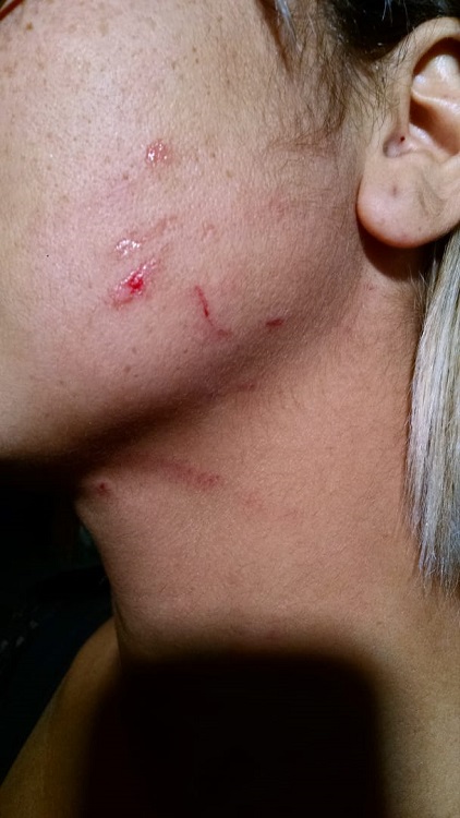 Foto mostra como ficou o rosto da manicure após as agressões da vendedora (Foto: Júlia Afonso/AT)
