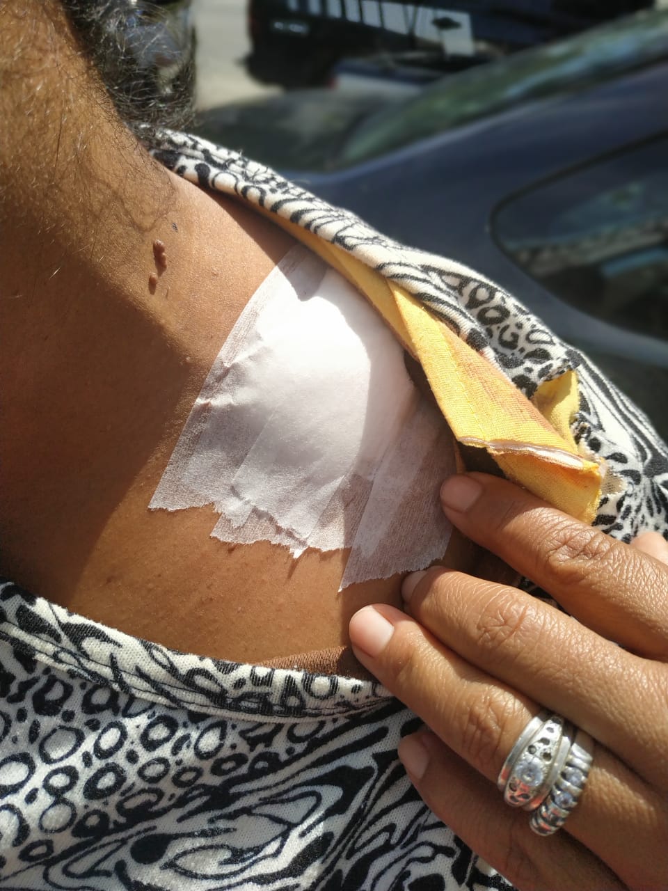 A atendente foi ferida com um golpe de facão no ombro esquerdo (Foto: Kananda Natielly)