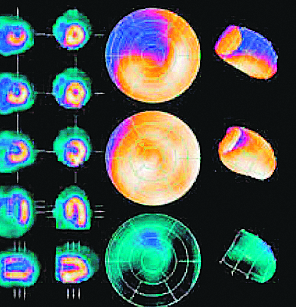 Resultado do exame PET/CT com PSMA, que está sendo oferecido  há pouco tempo no País. Ele demonstra onde estão  as lesões cancerígenas, sendo altamente relevante para a decisão da terapêutica a ser adotada (Foto: Divulgação)