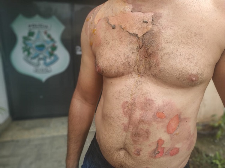 Homem mostra ferimentos causados por água fervente, jogada pela mulher (Foto: Kananda Natielly/AT)