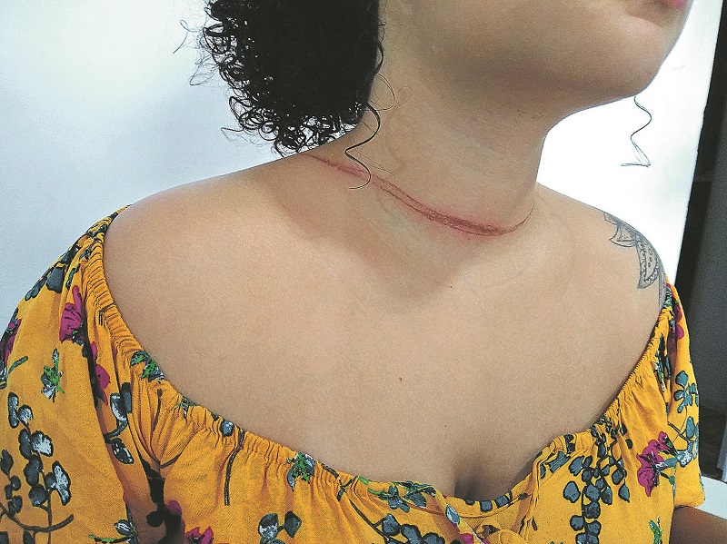 Letícia Lourenço mostra a marca que a linha deixou em seu pescoço. (Foto: Roberta Bourguignon)