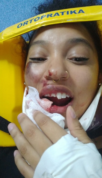 Monara sofreu o acidente após pneu da bicicleta ficar preso em um buraco (Foto: Reprodução/Arquivo Pessoal)