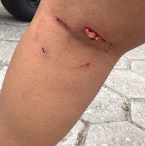 Universitária foi mordida no dia 25 de outubro (Foto: Reprodução/Instagram @profjadirlucas)