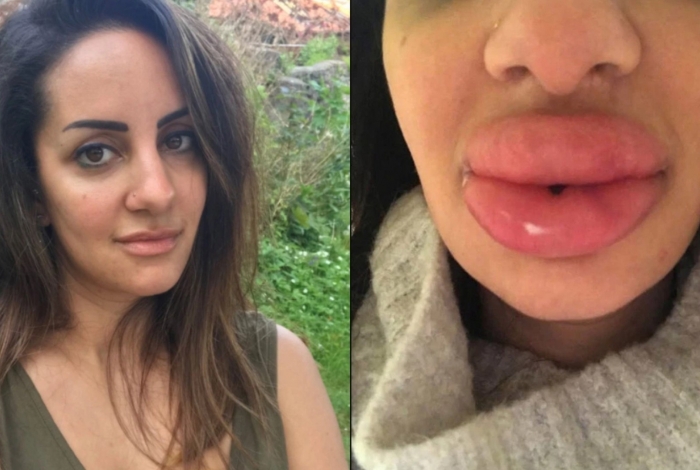 Antes e depois do procedimento labial: britânica de 30 anos precisou gastar quase R$ 4 mil para reverter processo. (Foto: Reprodução/Facebook)