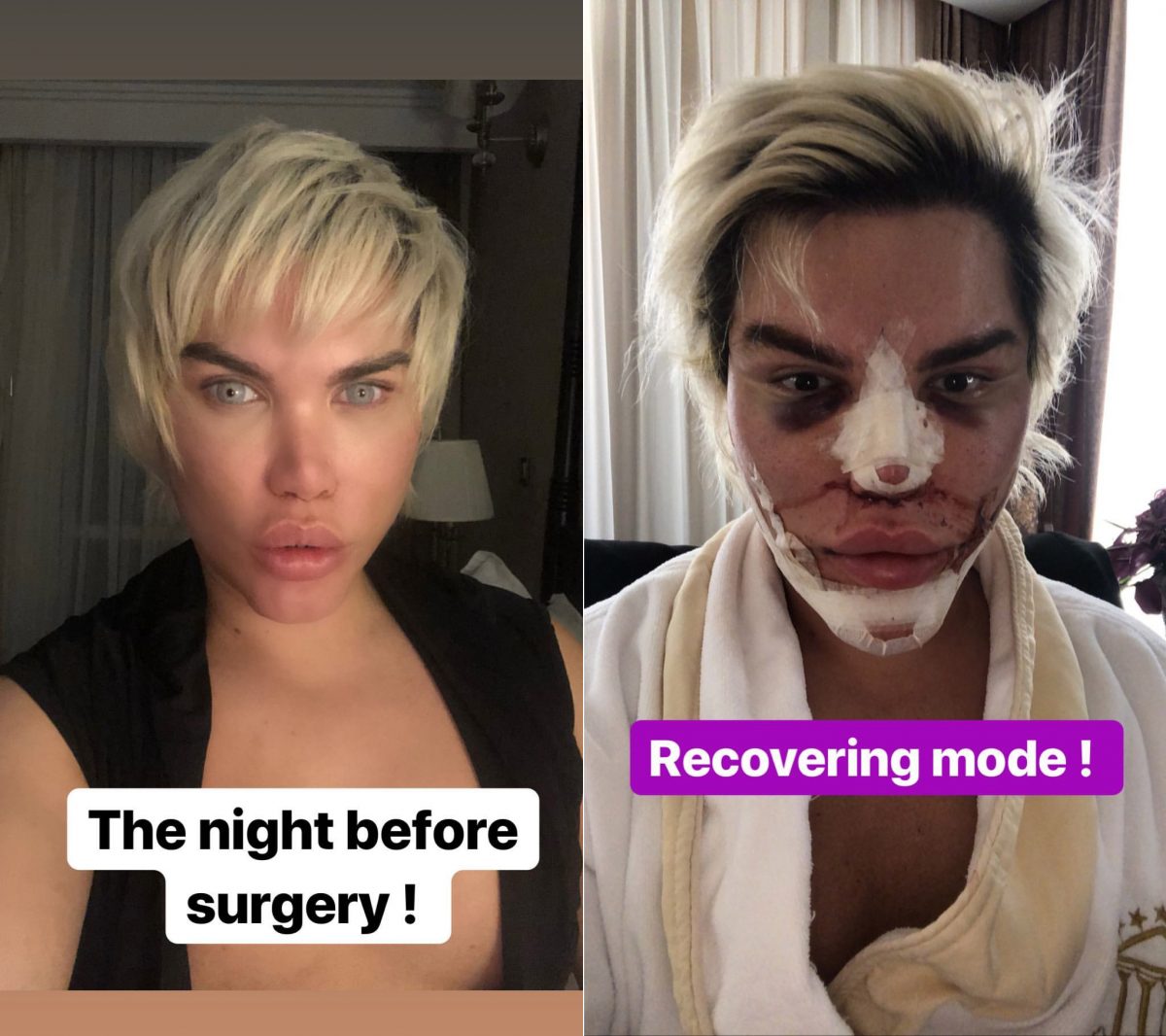 Em janeiro deste ano, ele fez a 11ª rinoplastia com o objetivo de corrigir procedimentos anteriores. Mas, embora inicialmente o resultado tenha sido positivo, o nariz começou a afundar novamente e ele agora sente dificuldades para respirar. (Foto: Reprodução)