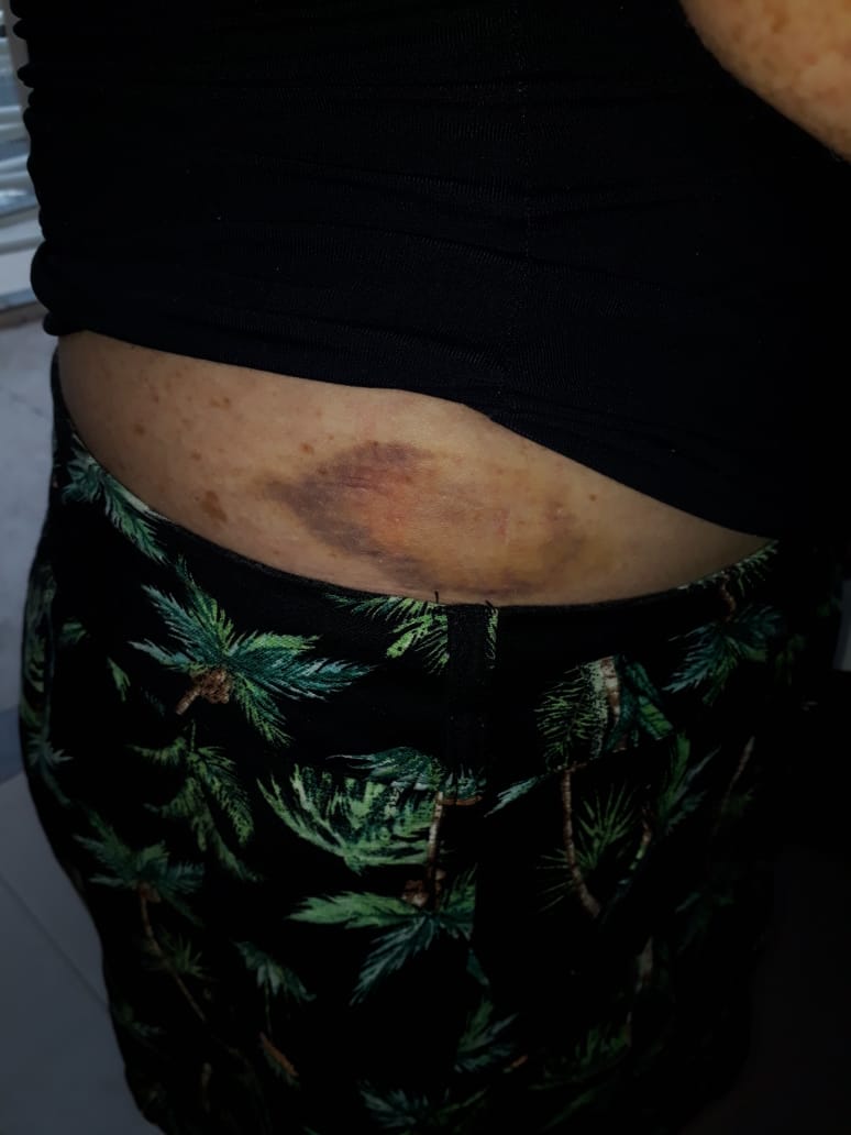 Um dos hematomas feitos pelo agressor (Foto: Patricia Maciel/AT)