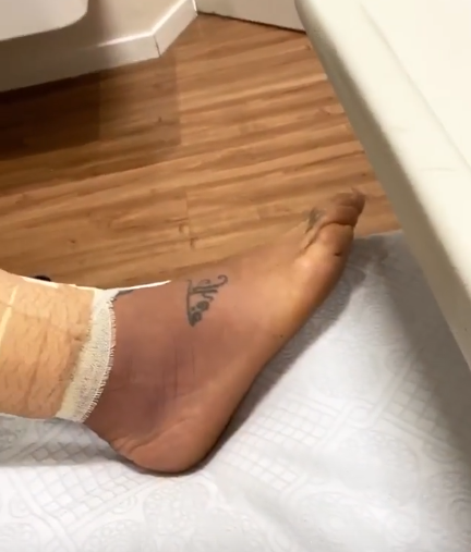O pé do ator ainda inchado e escuro, mesmo após tratamento (Foto: Reprodução/Instagram)