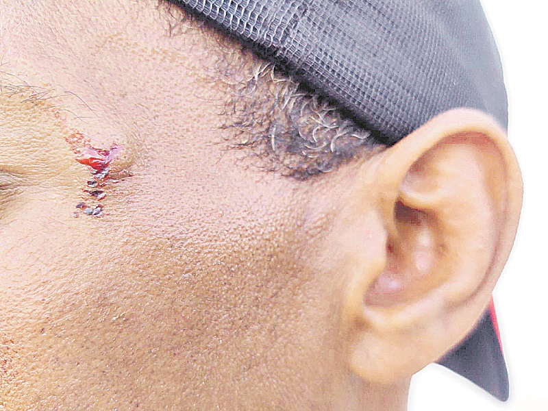 Marca que o cano da arma deixou no carpinteiro, após agressão. (Foto: Taynara Nascimento)