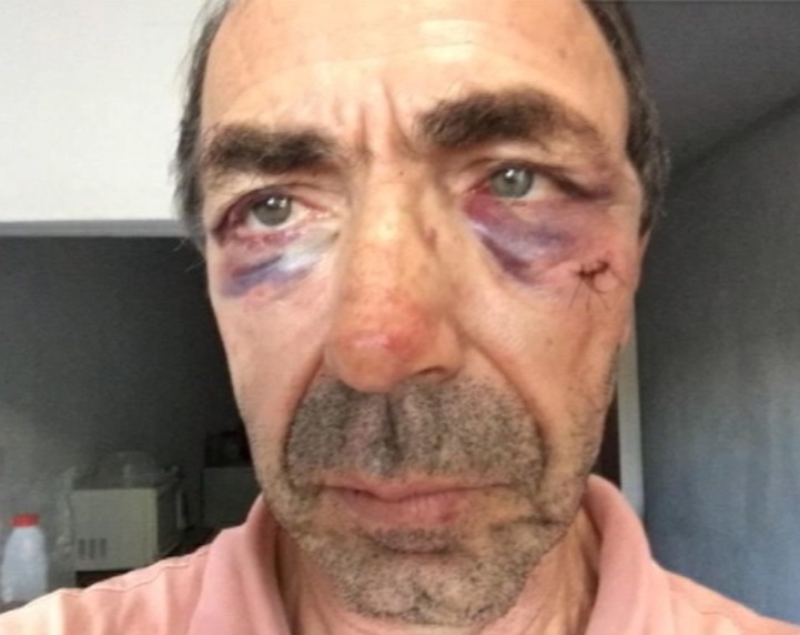 Idoso ficou com hematomas pelo rosto e mutos ferimentos pelo corpo. (Foto: Reprodução/TV Tribuna)