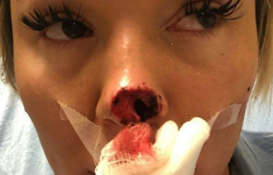 Allyson teve a ponta do nariz arrancada pelo namorado (Foto: Reprodução/GoFundMe)