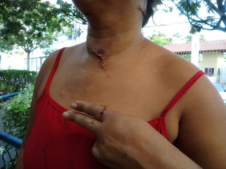 Cuidadora de idosos, de 41 anos, mostra ferimentos causados por desconhecido (Foto: Leone Oliveira/AT)