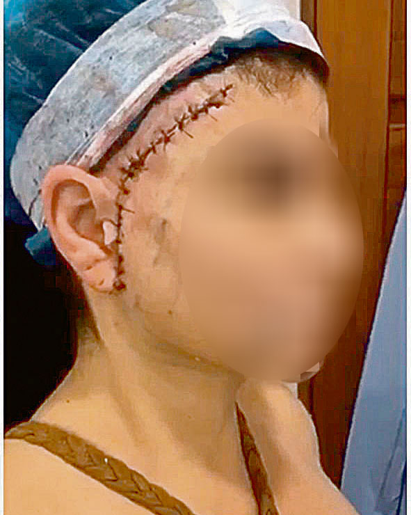 Marcas da cirurgia no rosto (Foto: Reprodução / Youtube)