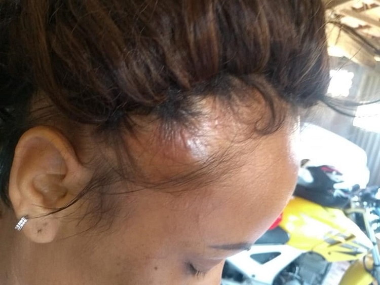 Edna dias após a aplicação do megahair (Foto: Reprodução/Arquivo Pessoal)