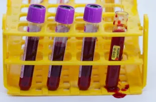 Imagem ilustrativa da imagem Exames dão negativo para coronavírus em cinco dos seis pacientes do Estado