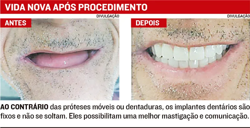 Imagem ilustrativa da imagem Implante dentário fica mais barato e atrai 20 mil por ano a consultórios