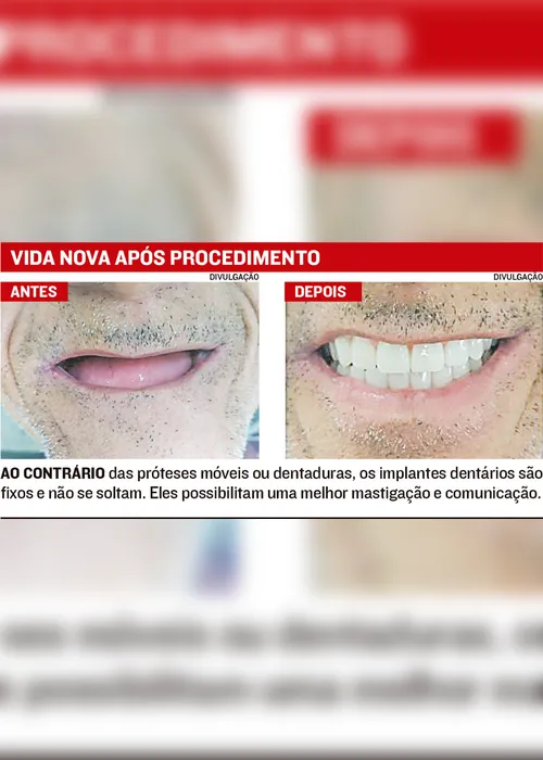 Imagem ilustrativa da imagem Implante dentário fica mais barato e atrai 20 mil por ano a consultórios