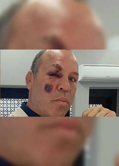 Imagem ilustrativa da imagem De bicicleta, Wanderlei Silva é atropelado em Curitiba e sofre fratura no pé