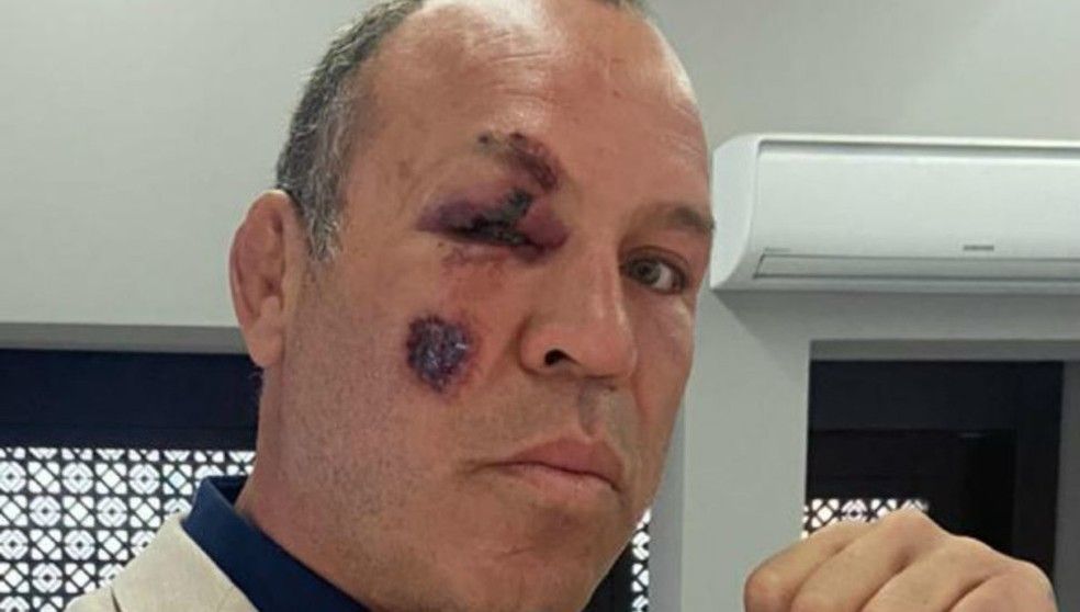 Wanderlei Silva quebrou o pé (Foto: Acervo Pessoal)