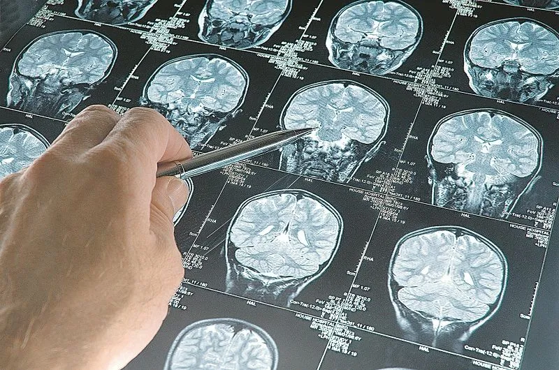 Imagem ilustrativa da imagem Danos cerebrais em pacientes com Covid