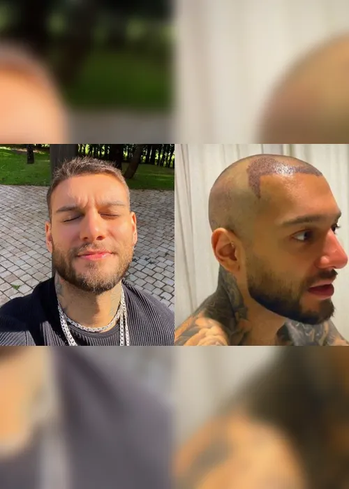 Imagem ilustrativa da imagem Lucas Lucco aparece careca e revela que fez implante capilar