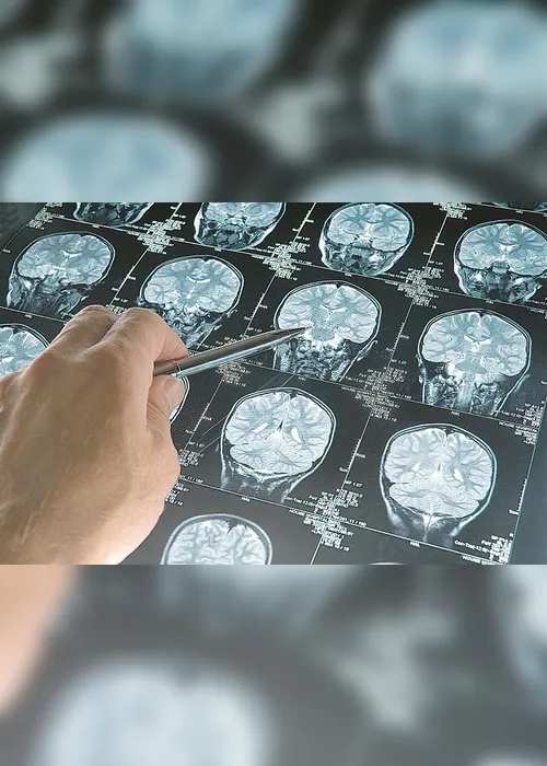 Imagem ilustrativa da imagem Danos cerebrais em pacientes com Covid