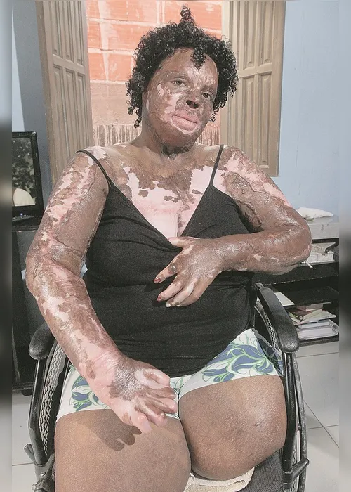 Imagem ilustrativa da imagem Queimada pelo ex-marido: "Perdoei, perdoei e olha como estou hoje?”