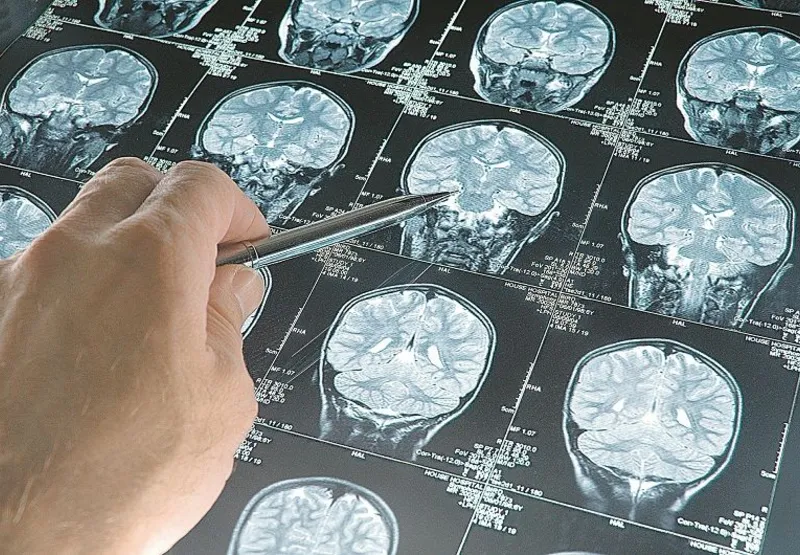 Médico analisa mapeamento cerebral: alerta para risco de doença neurológica severa após contato com o vírus
