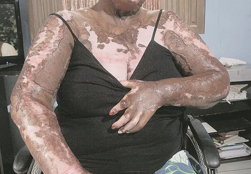 Marcilene Santos teve 40% do corpo queimado pelo ex-marido