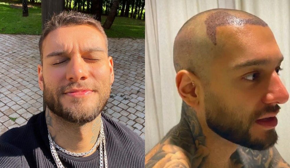 Antes e depois de uma cirurgia de transplante capilar feita por Lucas Lucco. (Foto: Reprodução/Instagram/@lucaslucco )