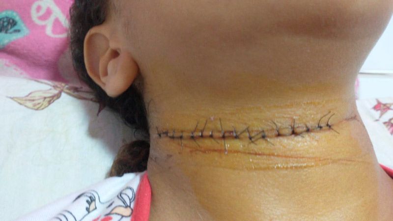 Pescoço da menina levou 16 pontos (Foto: Acervo Pessoal)