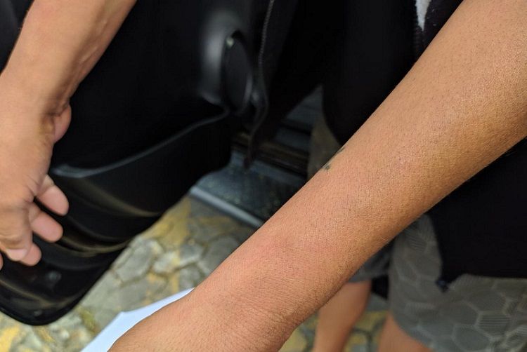 Mulher mostra marcas no pulso, onde foi amarrada pelo suspeito (Foto: Júlia Afonso/AT)