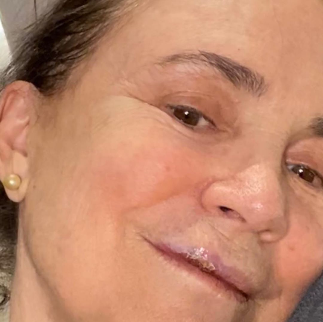 Atriz postou nas redes sociais fotos da boca machucada após queda (Foto: Reprodução Instagram @Reginaduarte)