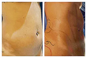 Imagem ilustrativa da imagem Lipo LAD: a nova arma para ter barriga tanquinho