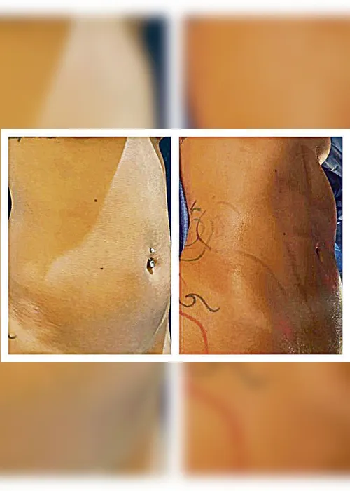 
          Imagem ilustrativa da imagem Lipo LAD: a nova arma para ter barriga tanquinho
          