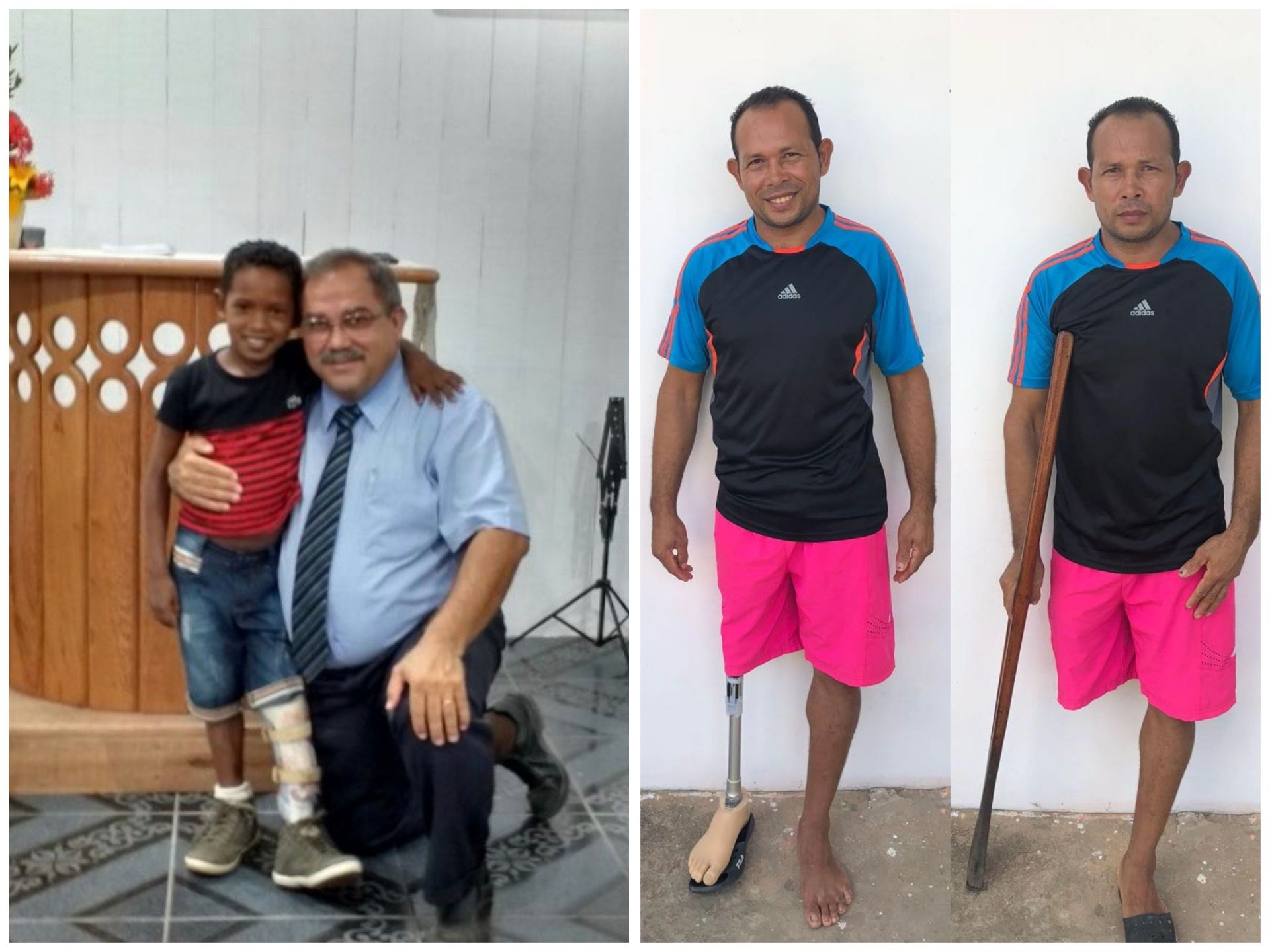 O pequeno Jhonildo com a órtese e Jairo com a prótese: atendimento recebido na Missão Amazônia