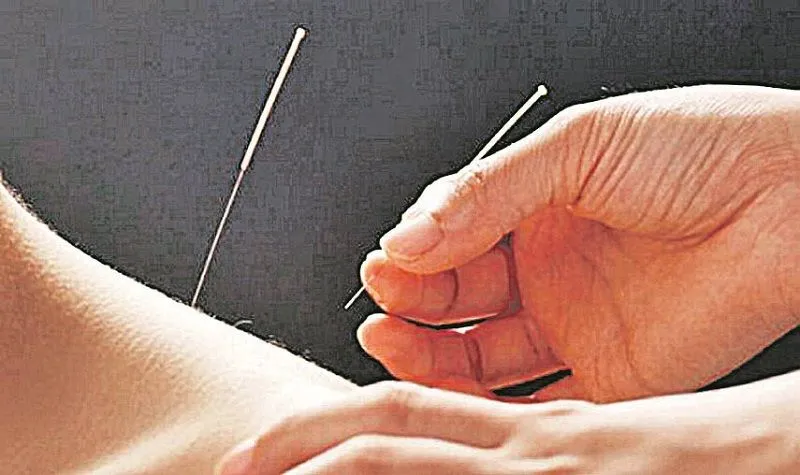 Sessão de acupuntura: técnica pode ser usada no tratamento 
de distensão muscular, rinite, sinusite, asma, dor de cabeça
 e crises de ansiedade