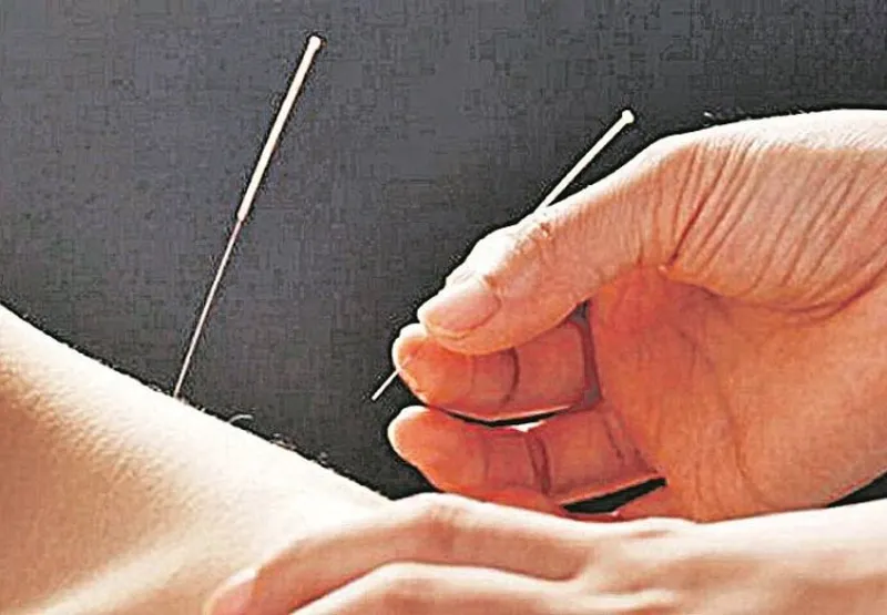 Sessão de acupuntura: técnica pode ser usada no tratamento 
de distensão muscular, rinite, sinusite, asma, dor de cabeça
 e crises de ansiedade