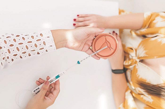 DIU deve ser inserido no útero por médico especialista. O dispositivo tem efeito contraceptivo por até 10 anos (Foto: Divulgação)