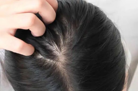 Principal responsável pela pediculose, junto com as lêndeas (ovos do inseto), o parasita é encontrado com maior frequência na cabeça dos seres humanos (Foto: Pixabay)