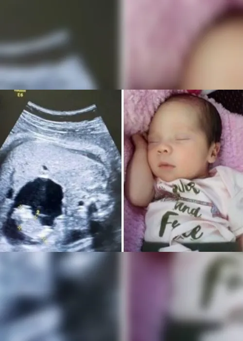 Imagem ilustrativa da imagem Condição rara faz bebê nascer 'grávida'